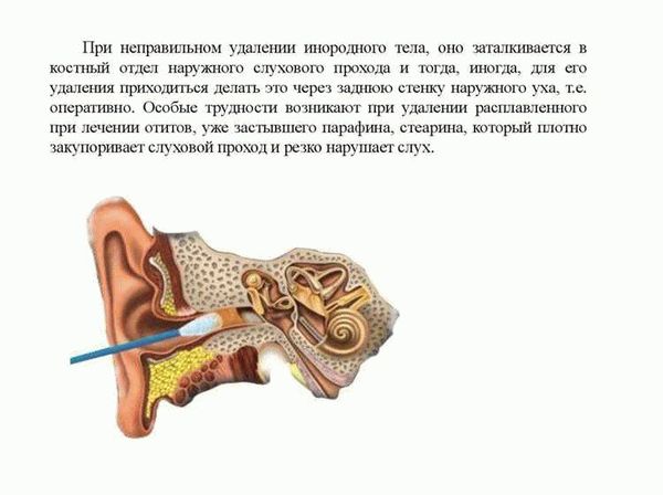 Что нельзя делать, если мошка попала в ухо?