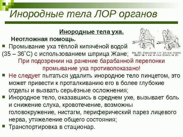 Удаление инородного тела уха у детей