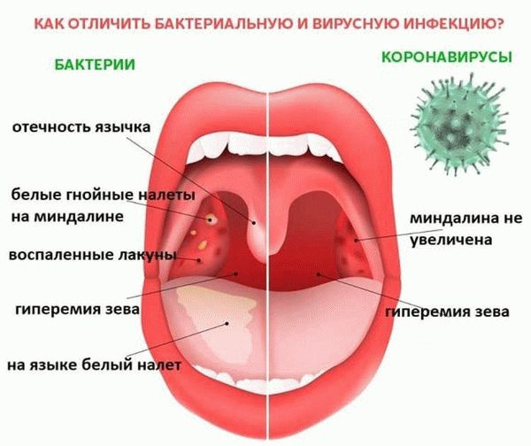 Как отличить бактериальную инфекцию от вирусной?