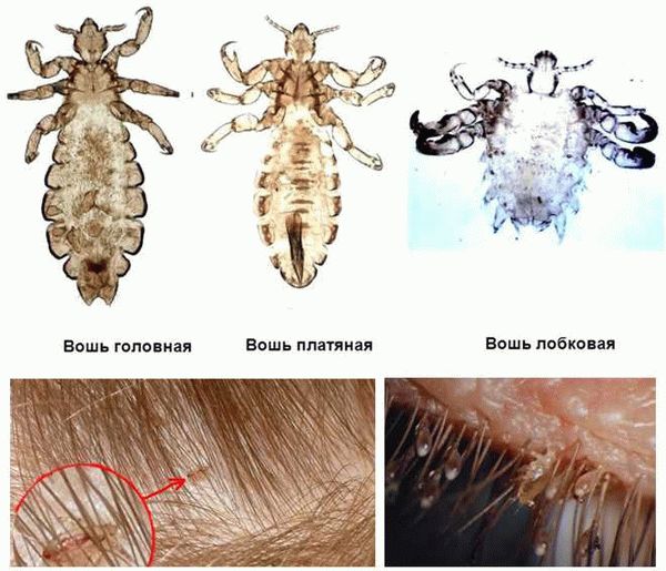 Отличия бельевых вшей от других паразитических насекомых