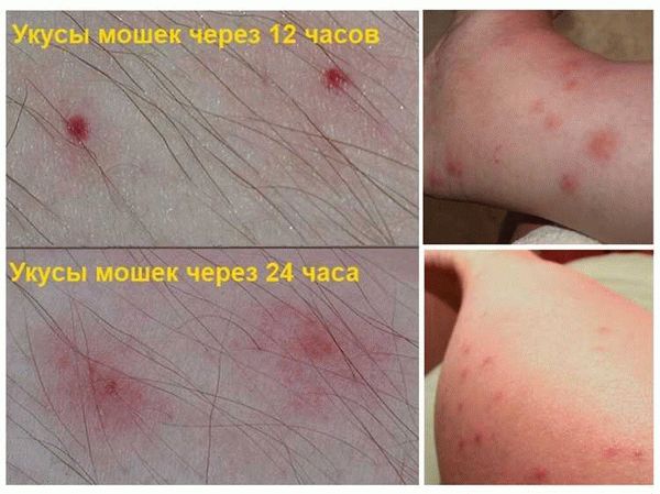 Вред, который наносит мошка своим укусом